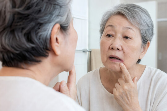 Older Woman Inspecting Angular Cheilitis at Mouth Corner in Mirror