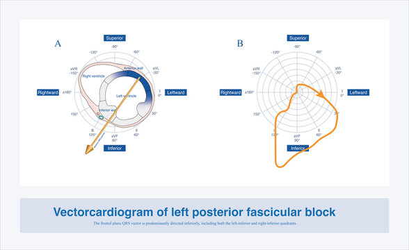 In left posterior fascicular block, the maximal QRS vector in the frontal plane is directed inferiorly and to the right, right axis deviatioin and the QRS complex in lead I exhibits an rS morphology.
