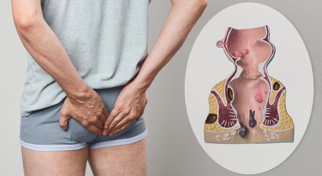 Medical collage of man holding his lower buttocks in pain and detailed anatomical model of rectum with hemorrhoids. Proctology diagnostic consultation and hemorrhoid treatment.