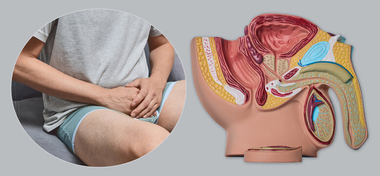 Medical collage of man sitting on sofa holding his groin and male pelvic organs anatomical model. Urology diagnostic consultation and prostatitis treatment.