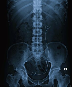 AP abdominal X-ray displaying left double J ureteral stent positioned in kidney and urinary bladder