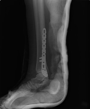 Lateral X-ray view of right ankle joint with contoured orthopedic plate and posterior immobilization cast