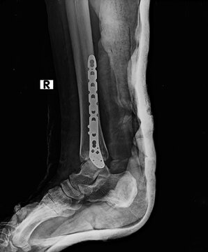 Lateral radiography of right ankle displaying surgical fixation plate with lateral marker and posterior splint