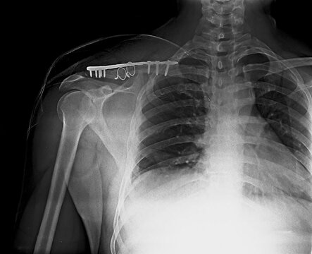Chest and shoulder X-ray showing surgical plate fixation with screws for clavicle fracture