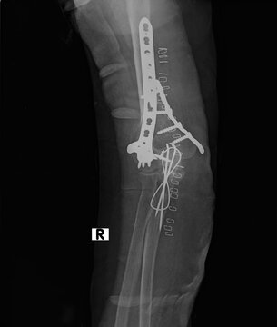 Anteroposterior elbow X-ray displaying distal humerus plate fixation and olecranon tension band wiring with skin staples