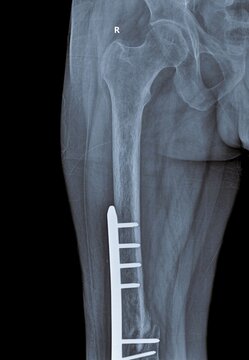 Proximal femur X-ray showing right hip joint and distal shaft internal fixation plate with screws