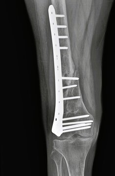 Anteroposterior distal femur X-ray displaying distal locking compression plate with multiple condylar screws