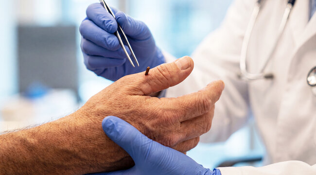 Medical professional prepares to remove a small wooden splinter from a patient's thumb using sterile tweezers during a minor procedure in a modern healthcare clinic.