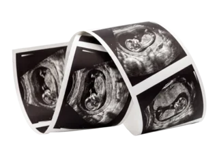 Baby ultrasound scan strip photo showing fetus development in pregnancy, displaying curling medical sonogram prints for prenatal care, obstetrics checkup, and family planning concepts. © Fernando