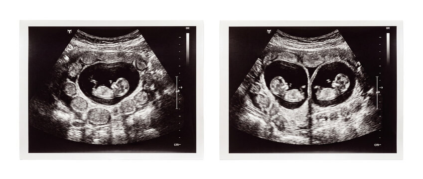 Baby ultrasound sonogram image comparison showing single fetus and twin fetuses during early pregnancy medical scan for obstetrics checkup, prenatal care, life development, and healthcare monitoring.