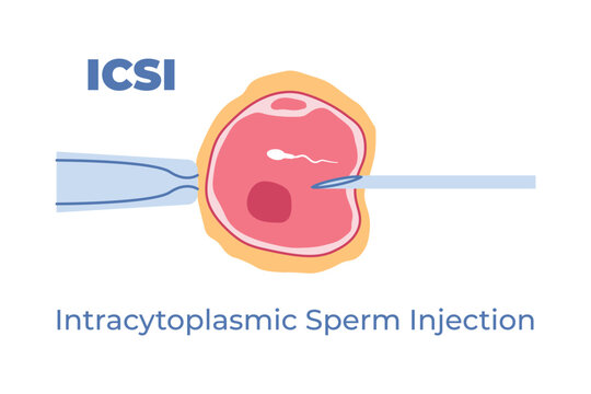 ICSI Intracytoplasmic sperm injection process, concept of assisted reproductive technology and fertility treatment - vector illustration