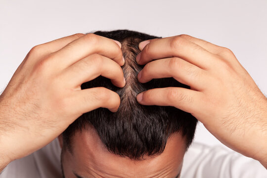 Close up of hands checking hair density on crown area to inspect scalp health and follicles during male pattern hair loss examination isolated over gray background