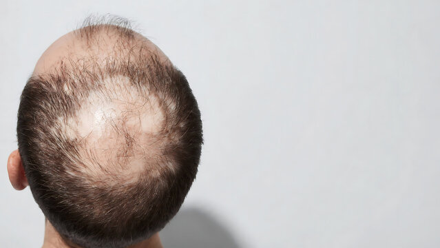 Close-up view of male pattern baldness on the crown of a man's head against a plain background