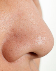 Fototapeta premium Extreme close-up of oily nose skin with visible blackheads and pores