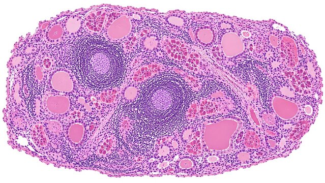 Hashimoto Thyroiditis Histopathology H&E