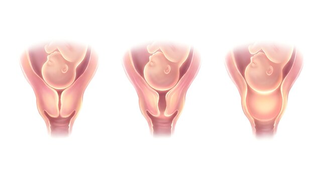 Stages of cervical dilation and effacement during labor