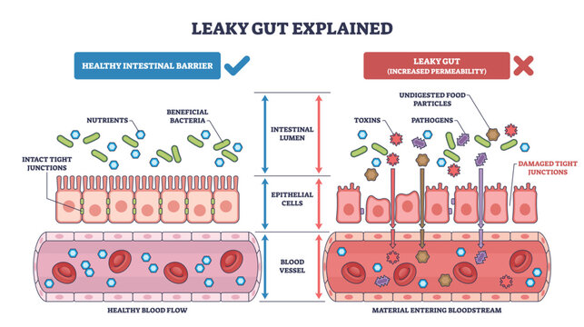 Leaky gut syndrome shown, epithelial cells, tight junctions, and a blood vessel compare healthy barrier vs increased permeability letting toxins enter the bloodstream. Diagram