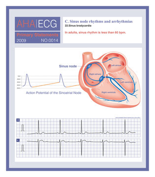 When the pacemaker cells of the sinoatrial node fire impulses at a slower rate, below 60 beats per minute, an electrocardiogram will record sinus bradycardia.
