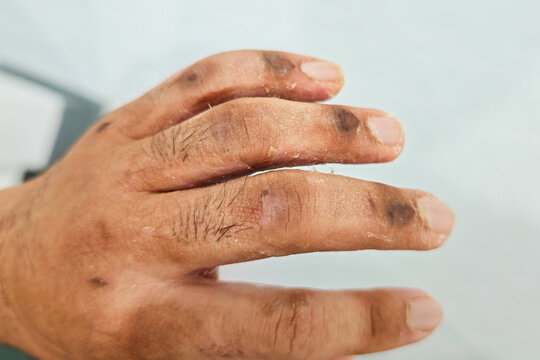 Human hand with skin damaged due to pressure sores wound and damp condition during broken finger treatment by using finger splint. Healthcare and medical scene, close-up with selective focus.