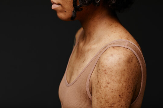 Woman with acne scars on skin against black background