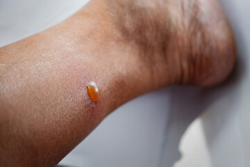 Fototapeta premium Close up. Blisters caused by insect bites, particularly sandfly bites, on a man's leg resulted in an allergic reaction..
