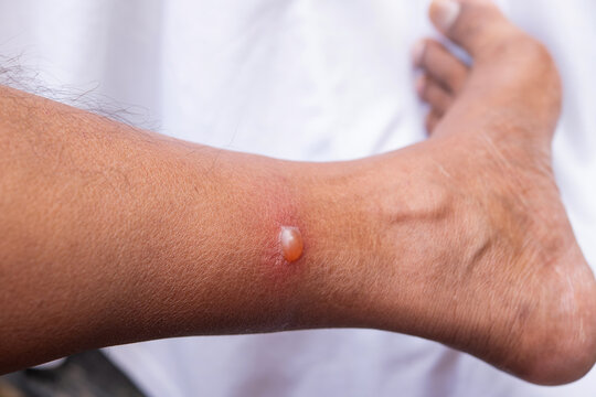 Close up. Blisters caused by insect bites, particularly sandfly bites, on a man's leg resulted in an allergic reaction..
