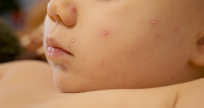 A child has chickenpox with blisters appearing on the face. The child is in a home setting. Parents may be concerned about the condition and its effects.