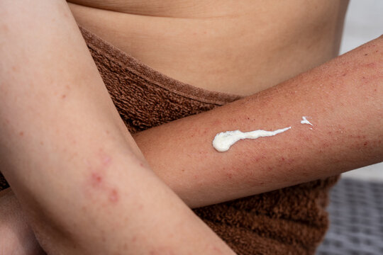 Close up of applying sunscreen cream to arm with visible skin redness, daily skincare routine and sun protection for sensitive skin