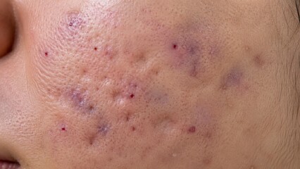 Fototapeta premium Close-up of human skin with severe acne scars and inflamed red pimples on cheek surface
