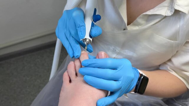 A podiatrist wearing blue protective gloves performs a professional medical pedicure, carefully treating the patient's feet with precision, hygiene and clinical care. Close up.