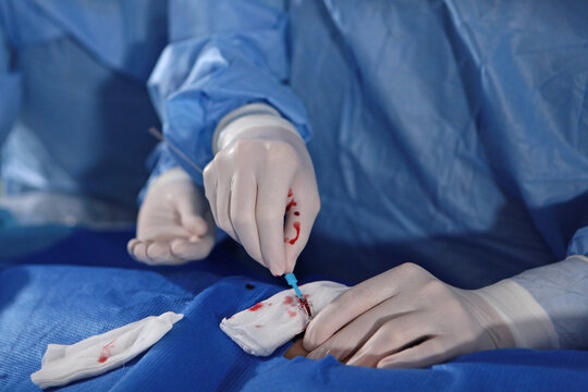 Surgery on blood vessels. Removal of blood clots. Patient is under general anesthesia. Prevention of blood clots. Surgeons' hands. Modern medicine