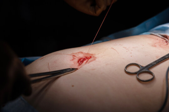 Navel is sutured at end of laparoscopic operation. Surgical intervention in abdominal cavity through navel. Laparoscopy in surgery. Surgeon's hands with medical instruments. Modern medicine