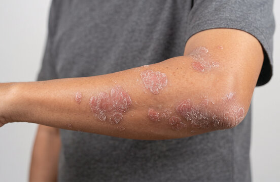 Close-up of human arm with red, scaly skin patches and psoriasis symptoms