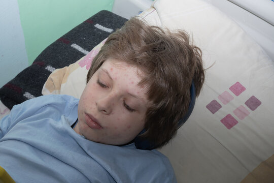 Child with chickenpox lesions on the face, neck and back demonstrating typical symptoms of varicella. Pediatric healthcare concept.