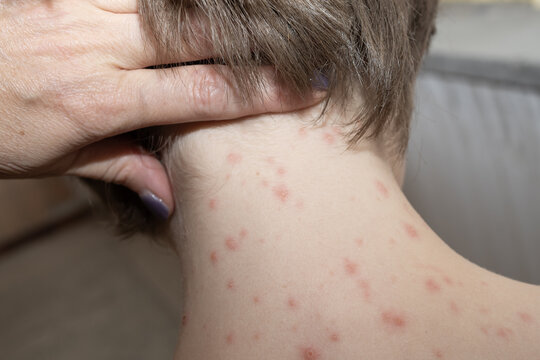 Child with chickenpox lesions on the face, neck and back demonstrating typical symptoms of varicella. Pediatric healthcare concept.