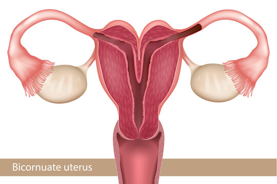 Bicornuate Uterus Congenital Uterine Malformation Medical Anatomy Cross Section Illustration. Female Reproductive System