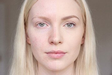 Naklejka premium Face before and after makeup skin care acne treatment cosmetic care