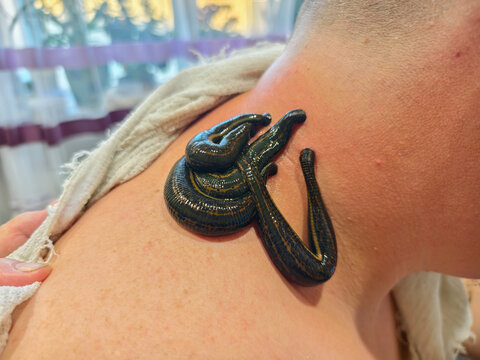 Medicinal leeches attaching to a person's neck for a natural hirudotherapy treatment, using a traditional alternative medicine approach for health and wellness.