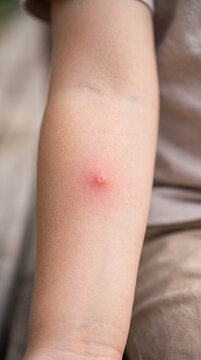 Child arm with red mosquito bite. Human skin with insect sting reaction. Allergy or irritation from pest. Concept of pest control and need for insect repellent to prevent bug bite.
