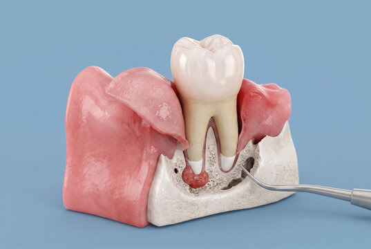 Detailed Anatomical Illustration of Human Tooth with Abscess and Dental Instrument for Medical Education