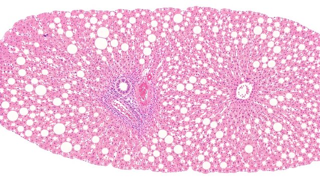 Liver Steatosis Histopathology H&E Microscopy Atlas