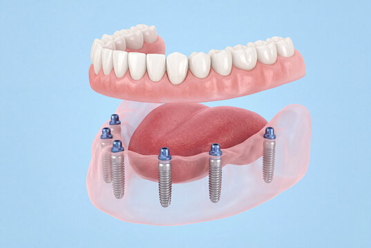 Detailed Rendering of Implant-Supported Overdenture System Highlighting Gum Base, Artificial Teeth, and Connectors for Dental Education
