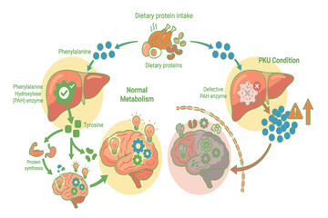 Naklejka premium Educational Phenylketonuria infographic explaining inherited metabolism disorder, newborn screening, neurological complications, diagnosis, and lifelong dietary therapy.