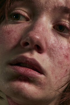 close up of scared female face with realistic blemishes or redness in rash, at night 
