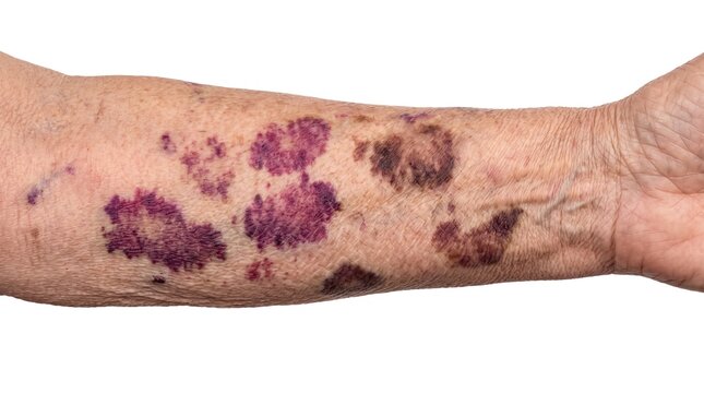 Arm of elderly person with senile purpura, showing large purple bruises and blood spots on fragile aging skin