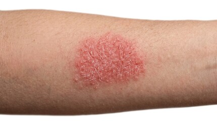 Fototapeta premium Close up of dry flaky skin patch on human arm, symptoms of psoriasis, eczema or ringworm fungal infection