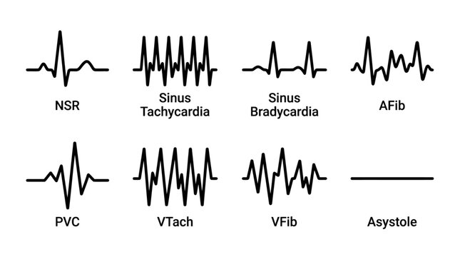 ECG heart rhythm types vector set, medical EKG wave diagrams for NSR AFib and Tachycardia, cardiology diagnostic heartbeat icons for healthcare education
