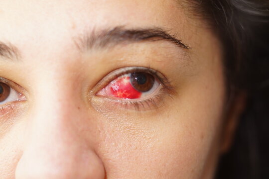 Close-up of an ethnic young woman's eye with a subconjunctival hemorrhage and broken blood vessel