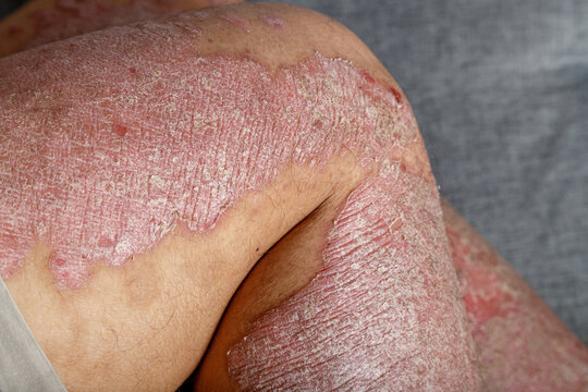 Close-up of inflamed dry scaly skin on a human leg, A chronic skin condition with redness, irritation, and flaky texture for healthcare and dermatology