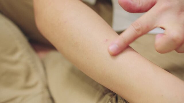 Close Up of Finger Touching Mosquito Bite Spot on Arm. Insect Repellent and Healthcare Concept.